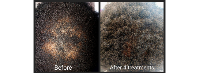 PRP Therapy: The Science and Benefits Behind the Hair Growth